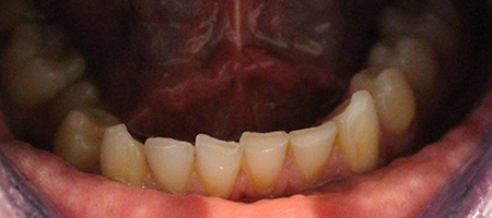 Before and After Invisalign Treatment Kingston Before and After Invisalign Treatment Kingston