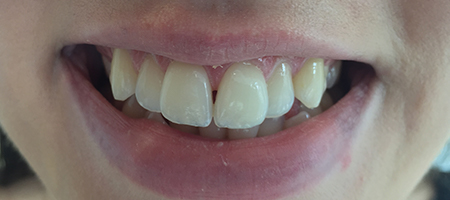 Before and After Invisalign Treatment Kingston Before and After Invisalign Treatment Kingston
