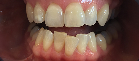 Before and After Invisalign Treatment Kingston Before and After Invisalign Treatment Kingston