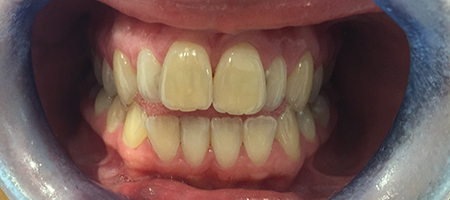Before and After Invisalign Treatment Kingston Before and After Invisalign Treatment Kingston
