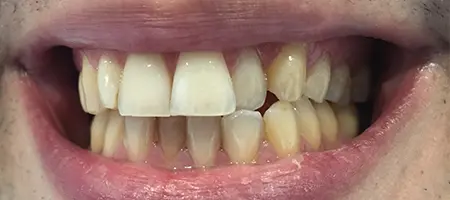 Before and After Invisalign Treatment Kingston Before and After Invisalign Treatment Kingston