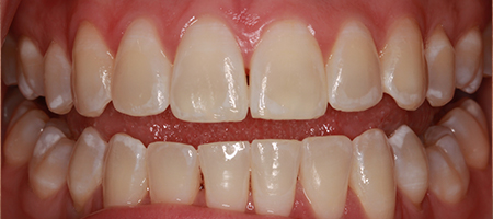 Before and After Invisalign Treatment Kingston Before and After Invisalign Treatment Kingston