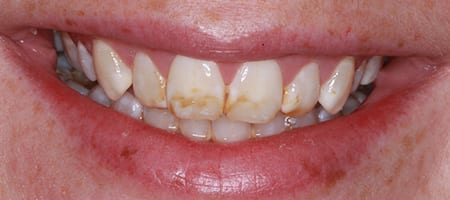 Composite Bonding Cases