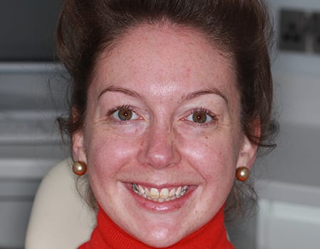 Composite Bonding Cases