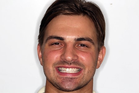 Before and After Invisalign Treatment Kingston Before and After Invisalign Treatment Kingston