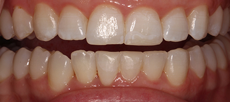 After Invisalign Treatment Reading Smiles After Invisalign Treatment Reading Smiles