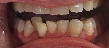 Before Invisalign Treatment Reading Smiles Before Invisalign Treatment Reading Smiles
