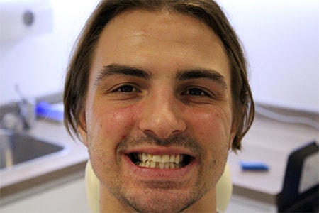 Before and After Invisalign Treatment Kingston Before and After Invisalign Treatment Kingston