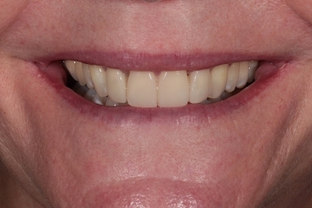 Before and After Invisalign Treatment Kingston