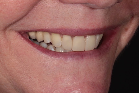 Before and After Invisalign Treatment Kingston