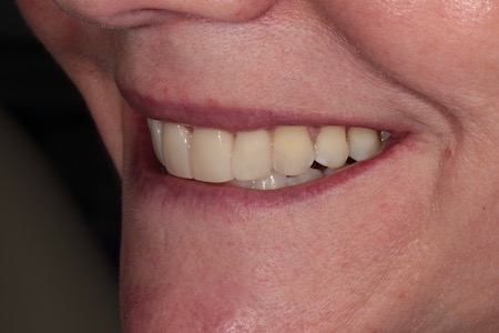 Before and After Invisalign Treatment Kingston