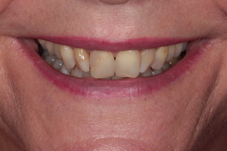 Before and After Invisalign Treatment Kingston