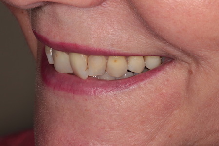 Before and After Invisalign Treatment Kingston