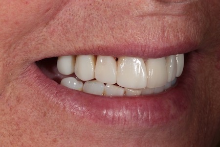 Before and After Invisalign Treatment Kingston