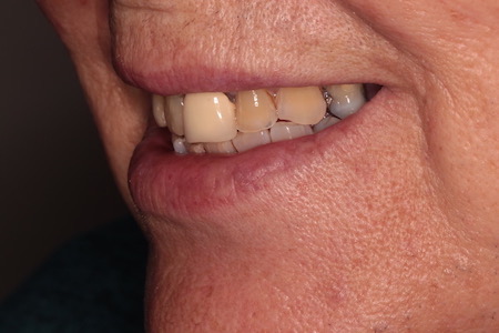 Before and After Invisalign Treatment Kingston