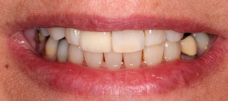 Before and After Invisalign Treatment Kingston