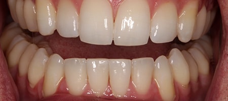 Before and After Invisalign Treatment Kingston Before and After Invisalign Treatment Kingston