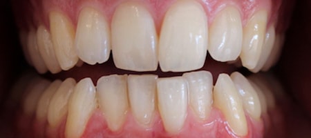 Before and After Invisalign Treatment Kingston Before and After Invisalign Treatment Kingston