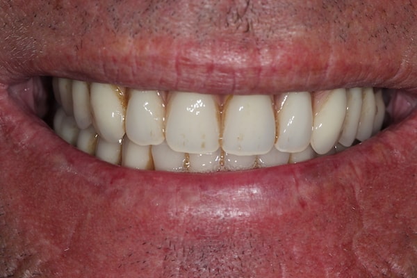 After Invisalign Treatment Reading Smiles