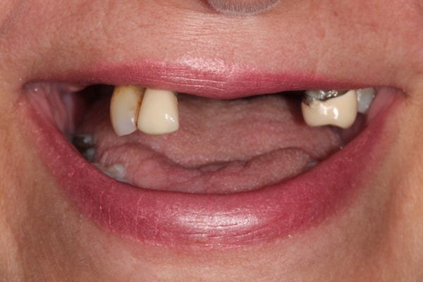 Before Invisalign Treatment Reading Smiles