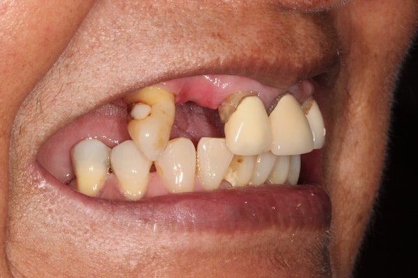 Before Invisalign Treatment Reading Smiles