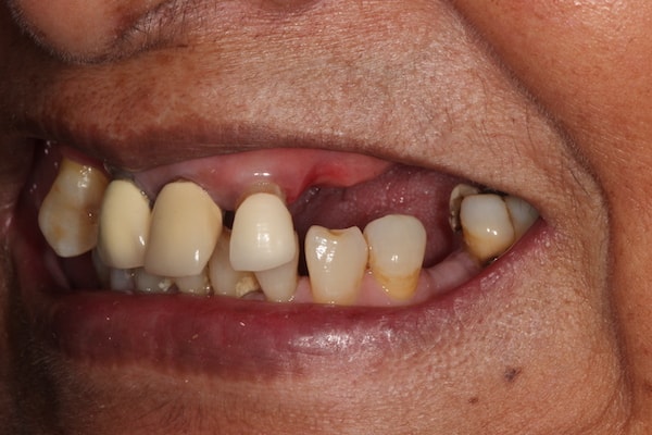 Before Invisalign Treatment Reading Smiles
