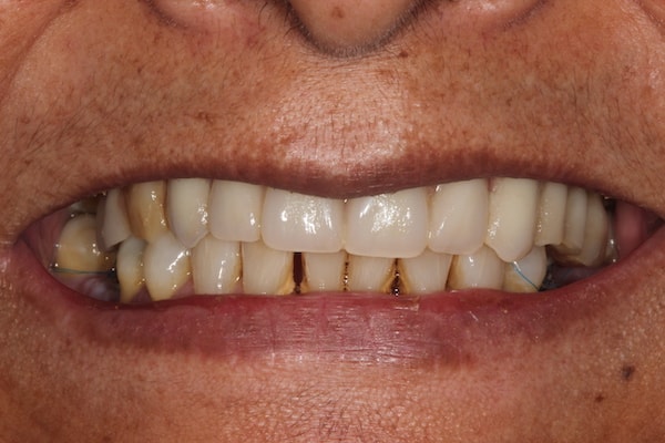 After Invisalign Treatment Reading Smiles