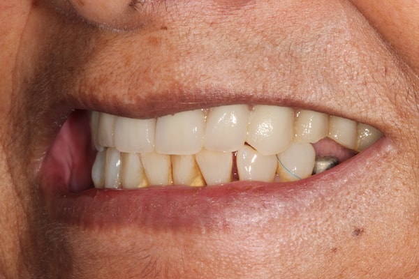 After Invisalign Treatment Reading Smiles
