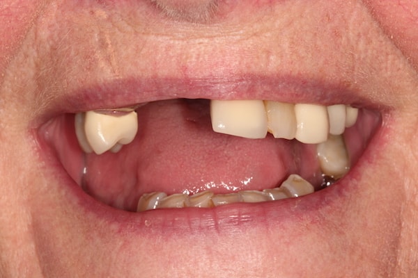Before Invisalign Treatment Reading Smiles