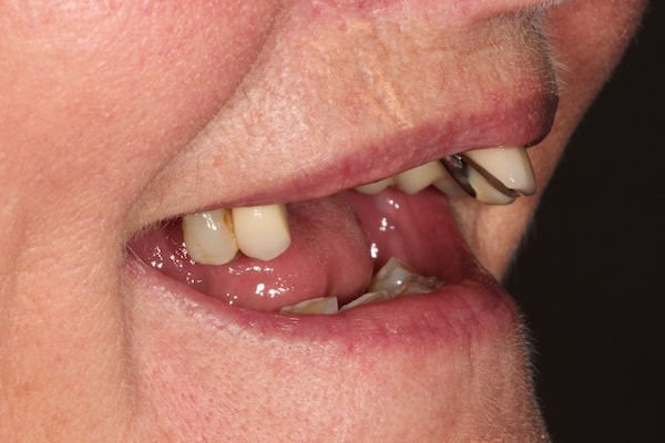 Before Invisalign Treatment Reading Smiles