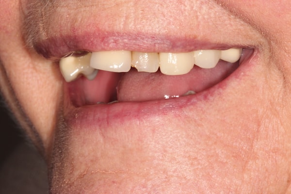 Before Invisalign Treatment Reading Smiles