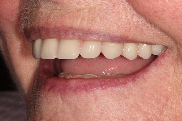 After Invisalign Treatment Reading Smiles