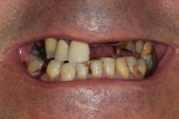 Before Invisalign Treatment Reading Smiles