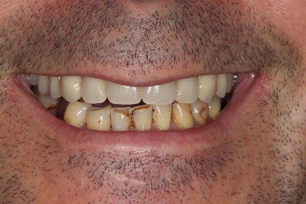 After Invisalign Treatment Reading Smiles