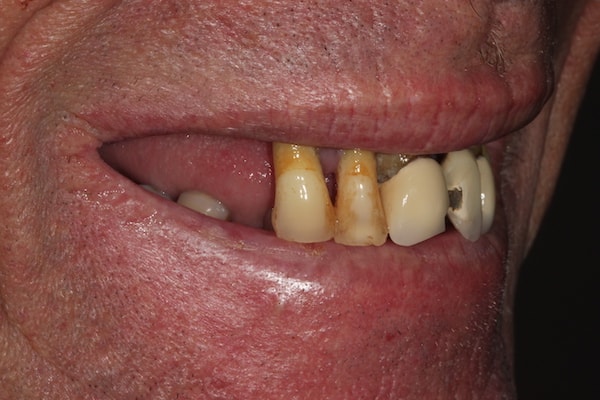 Implant cases