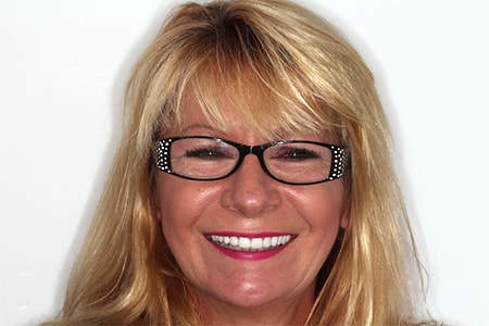 Before and After Invisalign Treatment Kingston