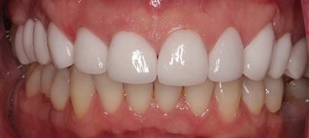 Before and After Invisalign Treatment Kingston