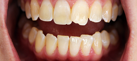 Before and After Invisalign Treatment Kingston Before and After Invisalign Treatment Kingston