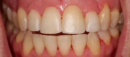 Before and After Invisalign Treatment Kingston Before and After Invisalign Treatment Kingston