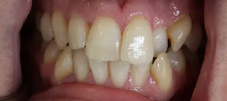 Before and After Invisalign Treatment Kingston Before and After Invisalign Treatment Kingston