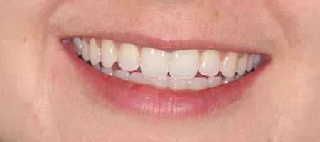 Before and After Invisalign Treatment Kingston Before and After Invisalign Treatment Kingston