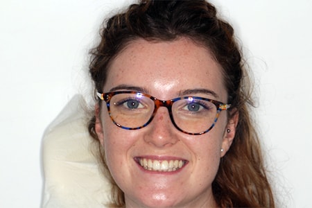 Before and After Invisalign Treatment Kingston Before and After Invisalign Treatment Kingston