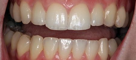 Before and After Invisalign Treatment Kingston Before and After Invisalign Treatment Kingston