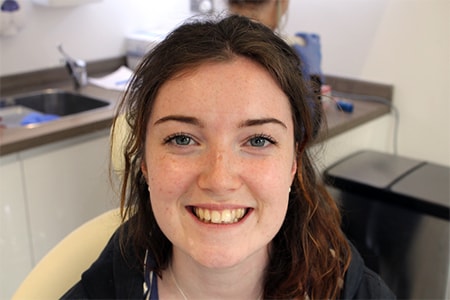 Before and After Invisalign Treatment Kingston Before and After Invisalign Treatment Kingston