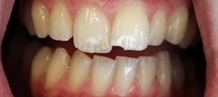 Before and After Invisalign Treatment Kingston Before and After Invisalign Treatment Kingston