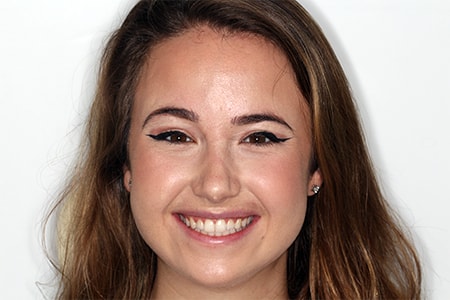 Before and After Invisalign Treatment Kingston Before and After Invisalign Treatment Kingston