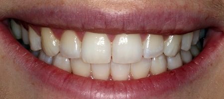 Before and After Invisalign Treatment Kingston Before and After Invisalign Treatment Kingston