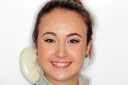 Before and After Invisalign Treatment Kingston Before and After Invisalign Treatment Kingston