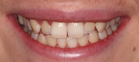 Before and After Invisalign Treatment Kingston Before and After Invisalign Treatment Kingston