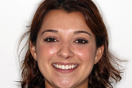 Before and After Invisalign Treatment Kingston Before and After Invisalign Treatment Kingston